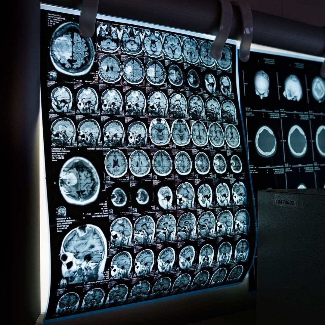 Close-up of a brain scan on a monitor representing cutting-edge neurological research and advanced treatment options.